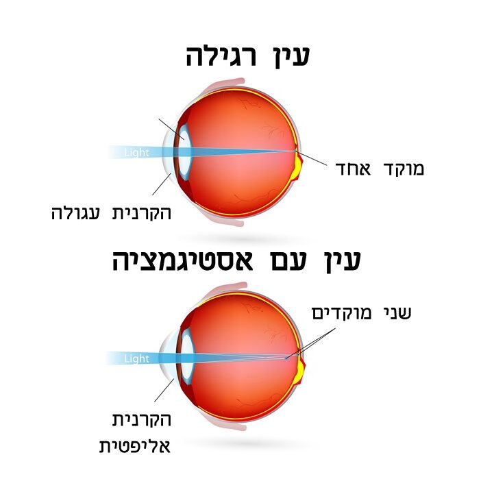 הדמייה אסטיגמציה גבוהה (צילינדר בעין). הדמיה על ידי ארזה פרוכטר הדמייה אסטיגמציה גבוהה (צילינדר בעין). הדמיה על ידי ארזה פרוכטר
